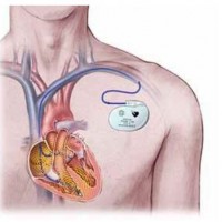 طرح توجیهی تولید دستگاه محرک ماهیچه های قلب